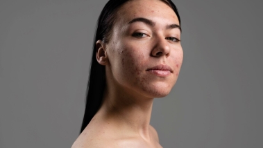 Skincare Routine for Hyperpigmentation